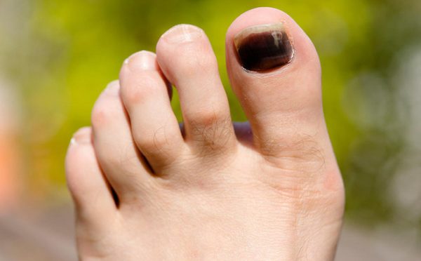 4 bước không thể bỏ qua khi bị dập ngón chân - Takumi Safety