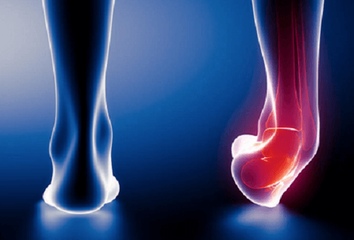 Bàn chân bẹt có thể gây bệnh về xương khớp